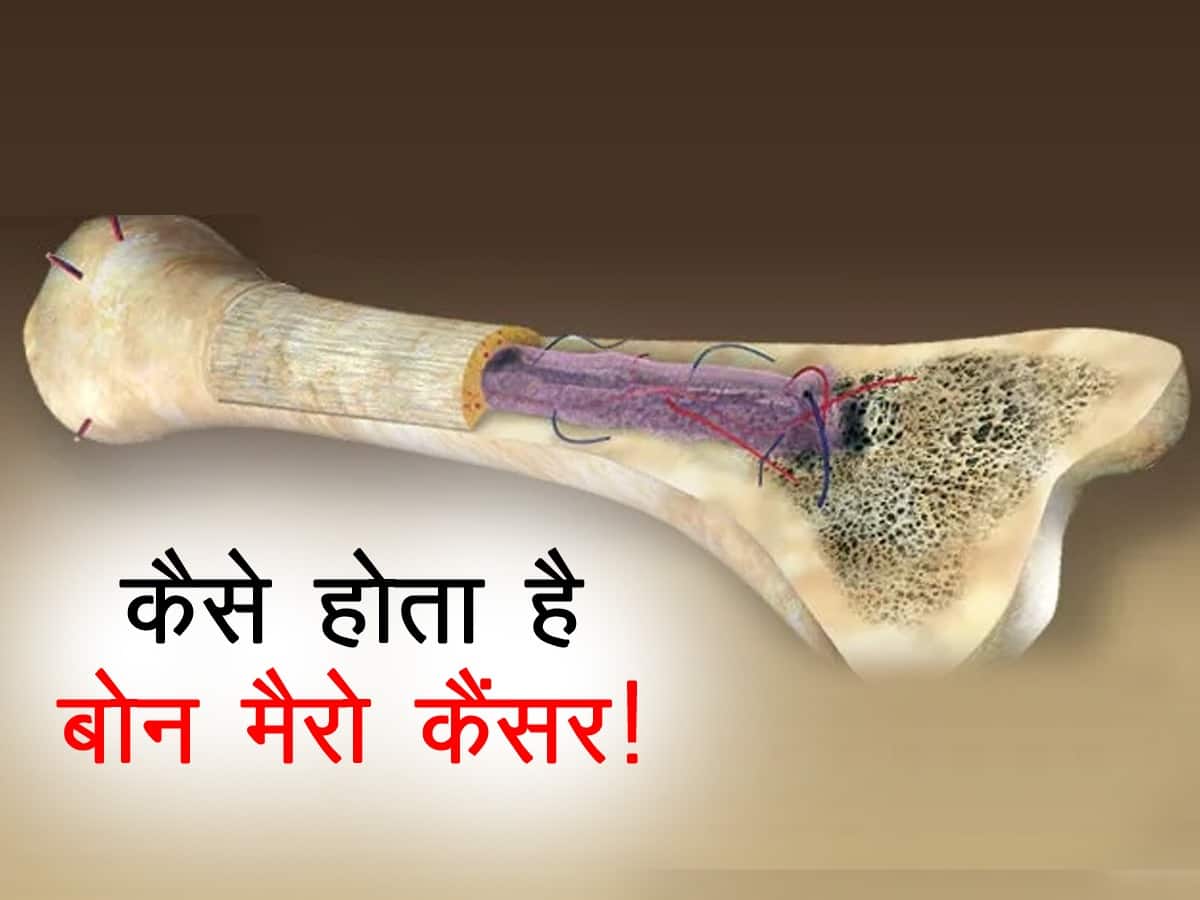 Bone Marrow Cancer warning signs in hindi : हड्डियों में होने लगे दुखन तो शरीर कर रहा है इस कैंसर का इशारा, जानें शरीर में दिखाई देने वाले आम बदलाव